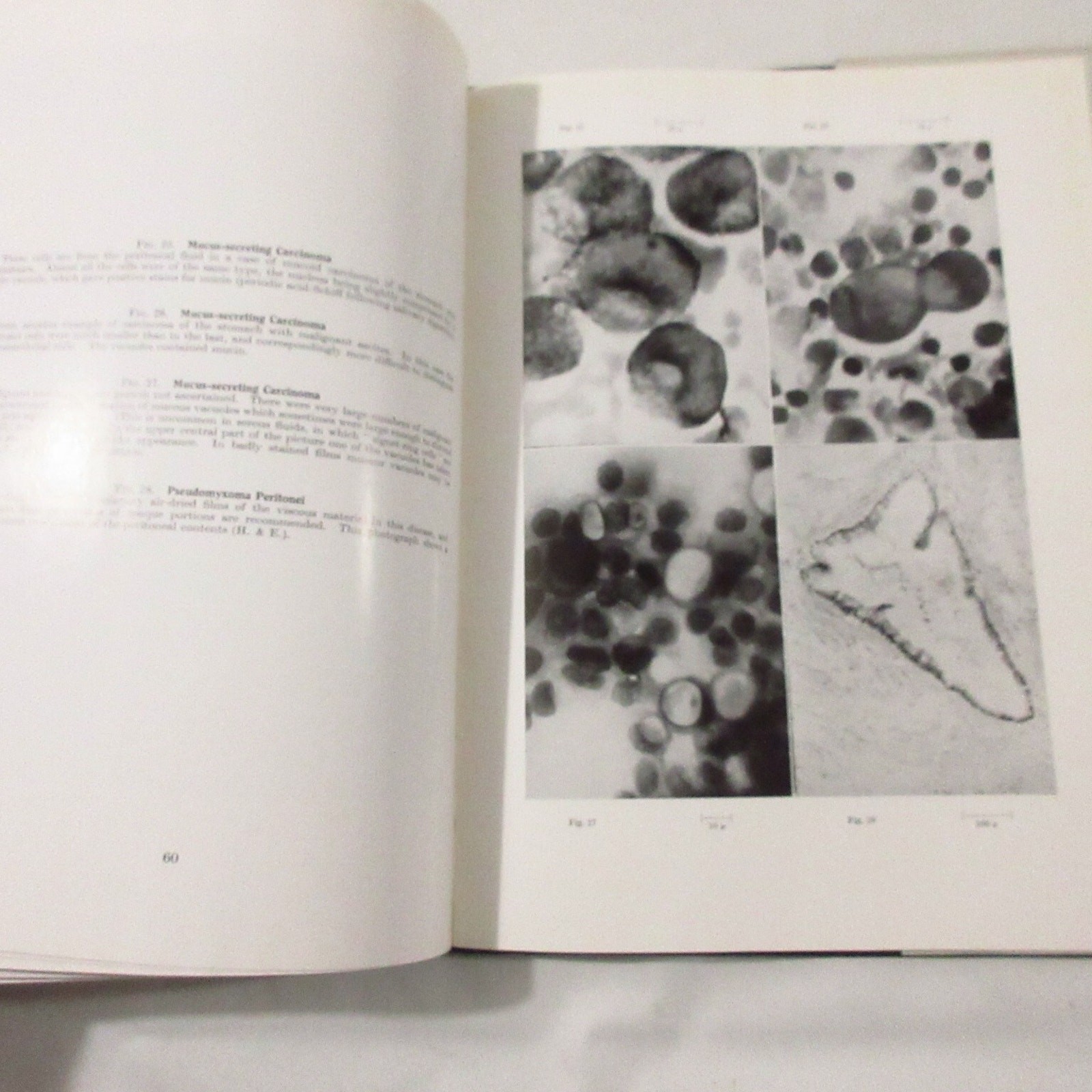 Vintage Medical Book Cancer Pathology Cytology of Effusions Spriggs Color Plates