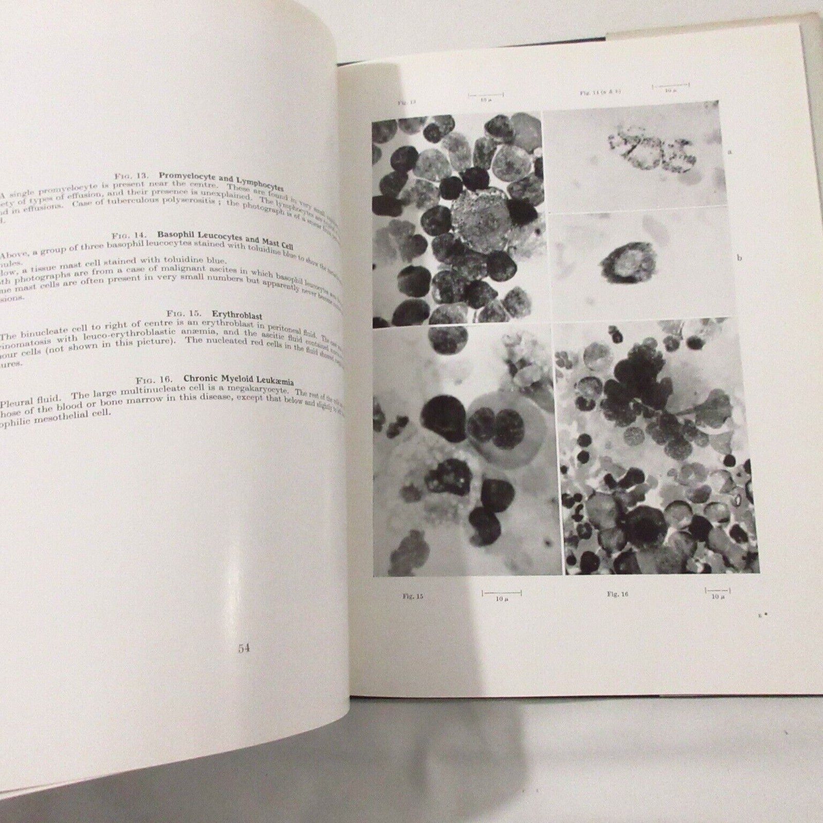 Vintage Medical Book Cancer Pathology Cytology of Effusions Spriggs Color Plates